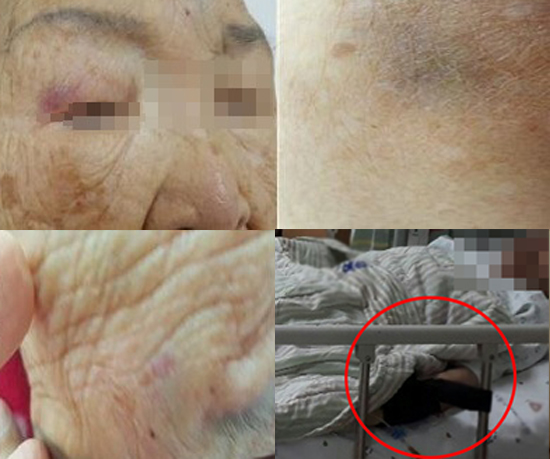 94세 환자가 간병인에게 폭행 당했다고 주장했다. 입술, 이마, 눈, 허벅지, 어깨, 다리 등의 상처. (사진= 제보자 이모씨 제공)